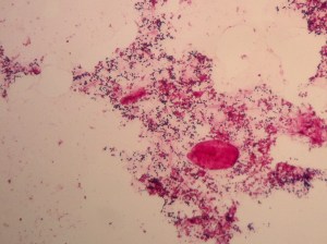 Gram stained smear of product, neat.